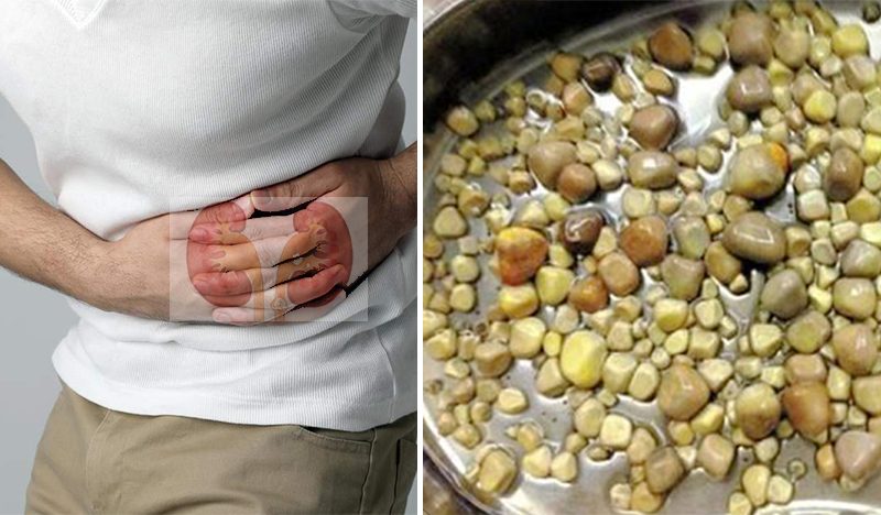 Kidney-Stones-800x468