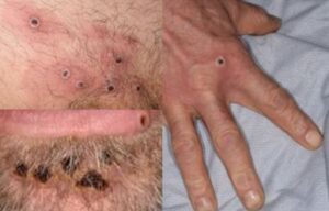 monkeypox_rash_lesions_image-1ed6