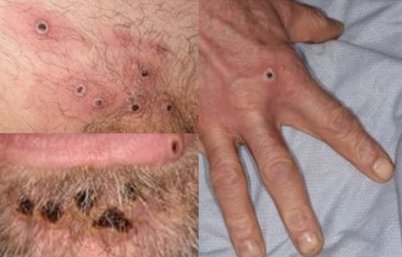 monkeypox_rash_lesions_image-1ed6